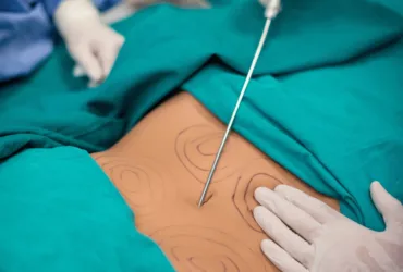 Is Liposuction Very Painful? What to Expect During and After Your Procedure