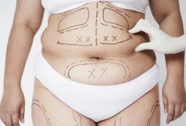 Is Liposuction Permanent? The Truth About Lasting Fat Loss Results