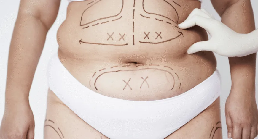 Is Liposuction Permanent? The Truth About Lasting Fat Loss Results