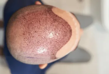 Scalp Numbness After a Hair Transplant A Surgeons Guide to Nerve Healing